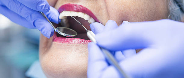 Best Knocked-Out Tooth (Avulsed Tooth) Treatment in Roslyn, NY
